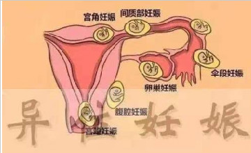異位妊娠預防知識